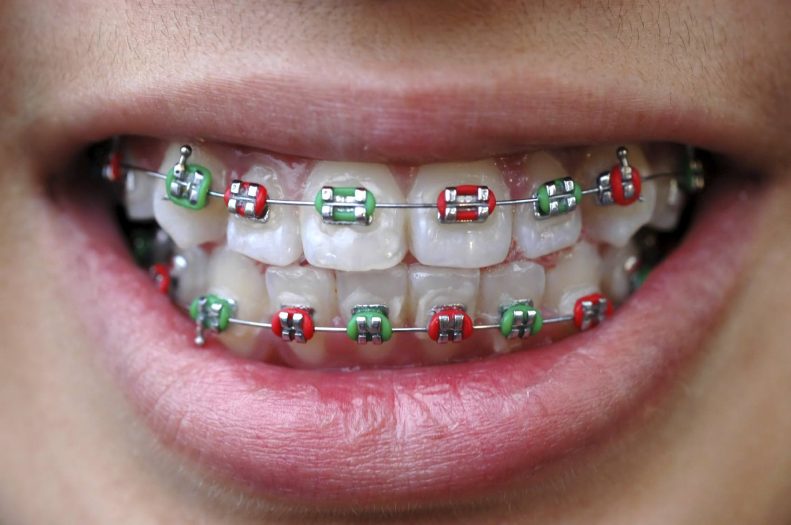 Emergency Braces Care Over the Holidays