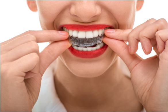 The First Week of Invisalign Treatment