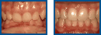 Deep Overbite: Lower Front Teeth Bite Into Palate