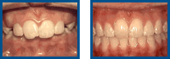 Overjet: Protruding Front Teeth