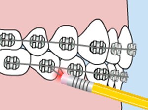 Poking Wire