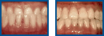 Underbite: Lower Front Teeth in Front of Upper Teeth