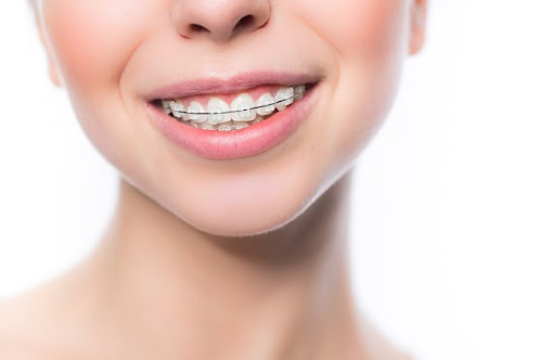 Clear Vs. Metal Braces